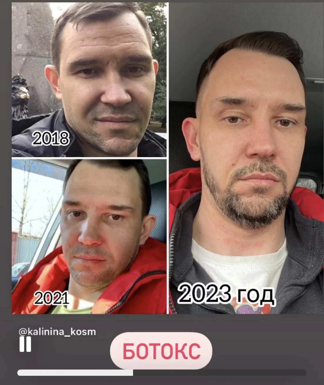 Ботокс нити  инъекции косметолог - миниатюра 18