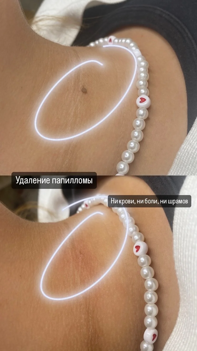 Удаление папиллом - миниатюра 2