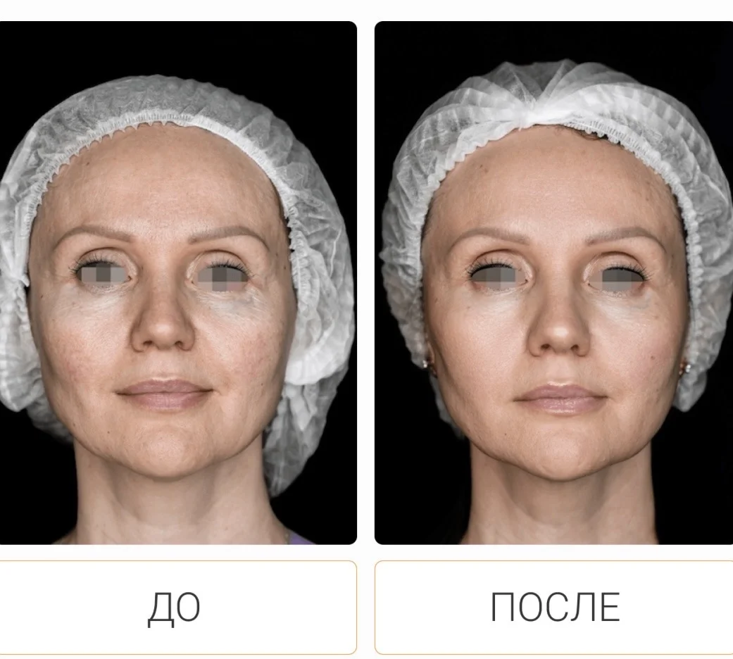 Косметолог/Ботокс/губы/биоревитализация/пилинг - миниатюра 18