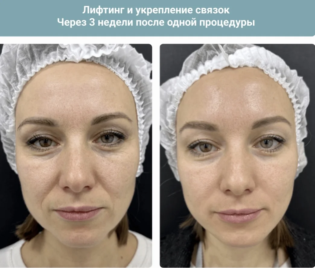 Косметолог/Ботокс/губы/биоревитализация/пилинг - миниатюра 21