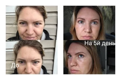 Холодная плазма/удаление папилом/подтяжка живота - миниатюра 4