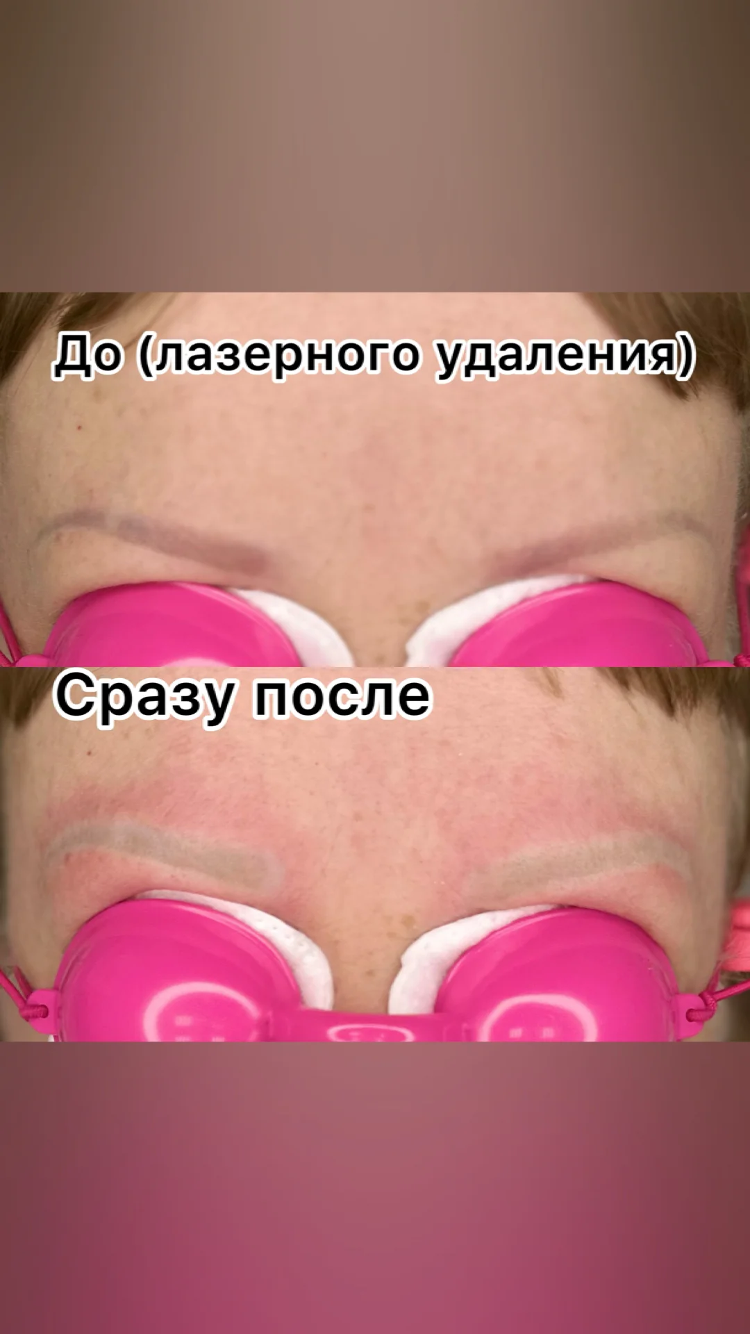 Удаление татуажа / тату - миниатюра 9