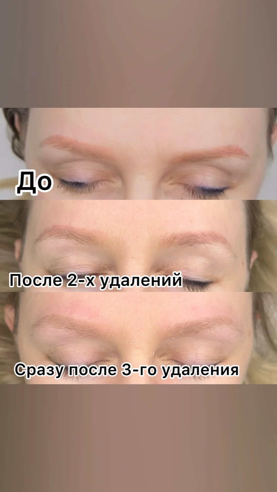 Удаление татуажа / тату - миниатюра 10