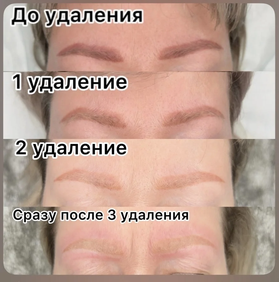 Удаление татуажа / тату - изображение 1