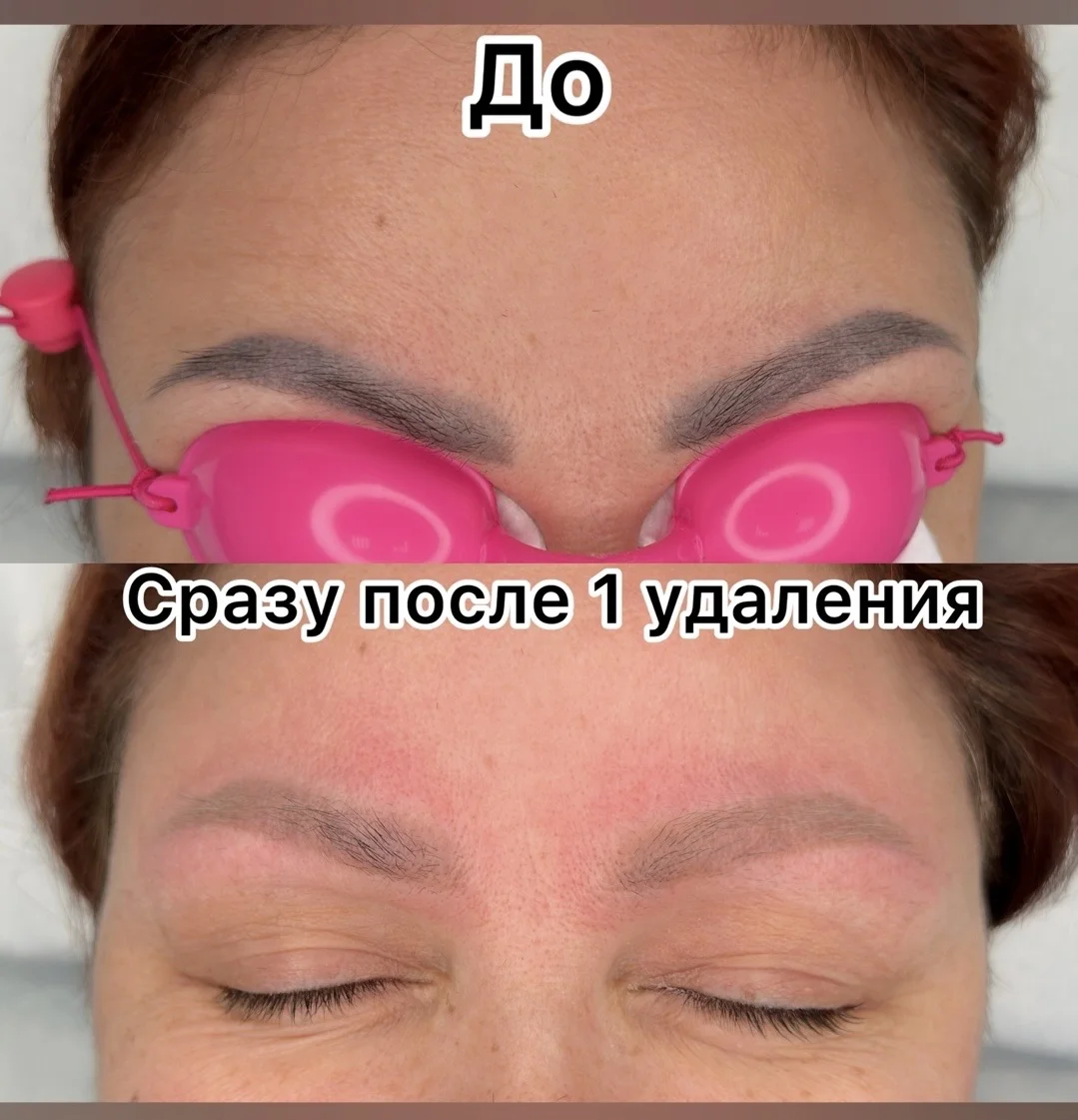 Удаление татуажа / тату - миниатюра 2