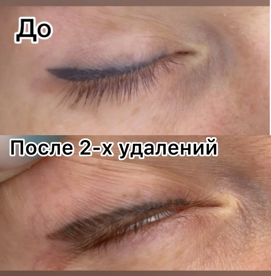 Удаление татуажа / тату - миниатюра 3