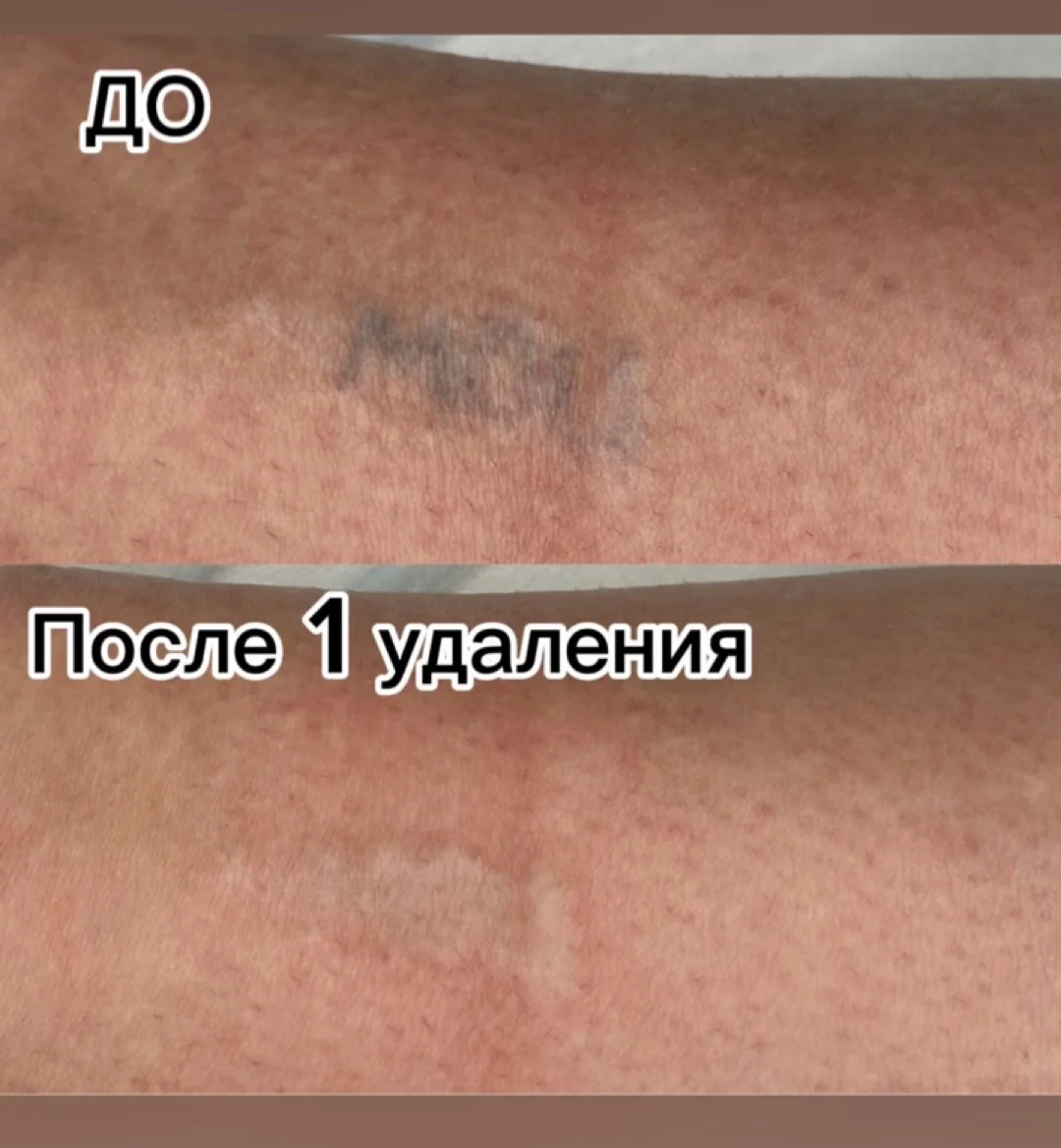Удаление татуажа / тату - миниатюра 4