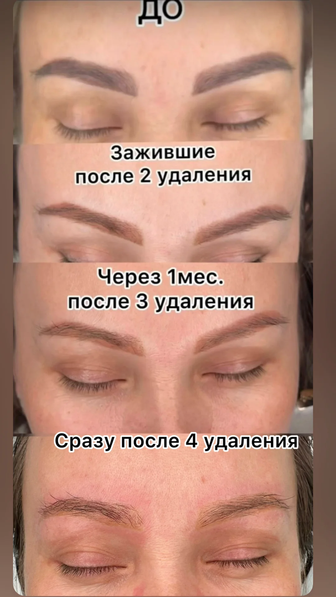 Удаление татуажа / тату - миниатюра 5