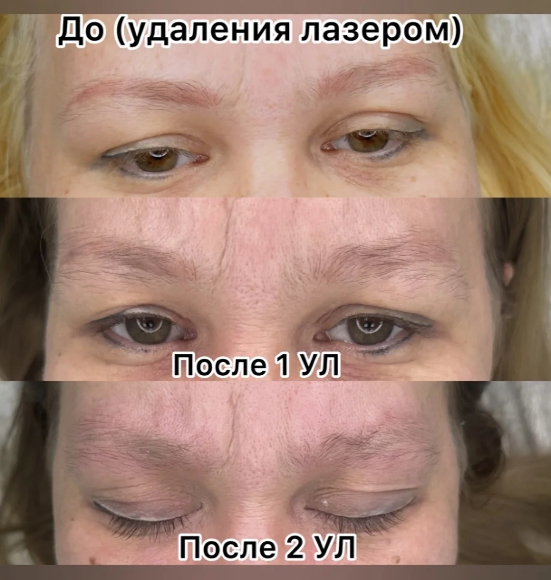 Удаление татуажа / тату - миниатюра 6
