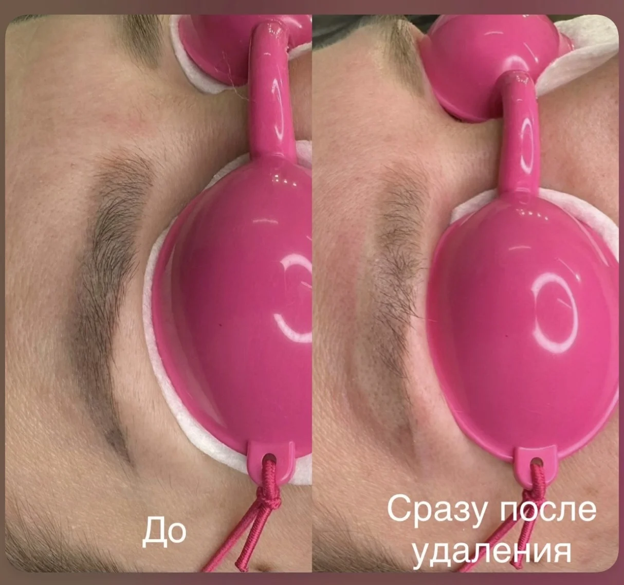 Удаление татуажа / тату - миниатюра 8