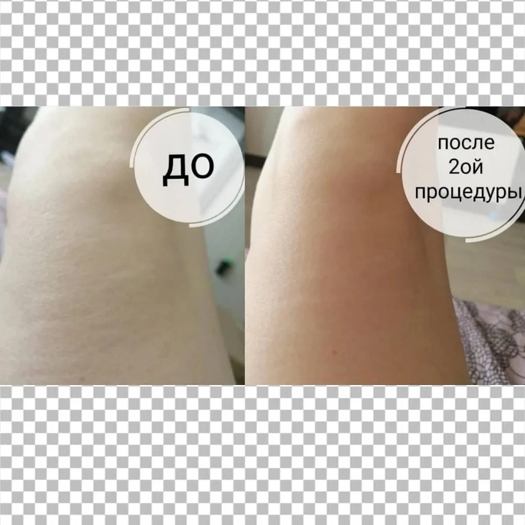 RF лифтинг - миниатюра 4