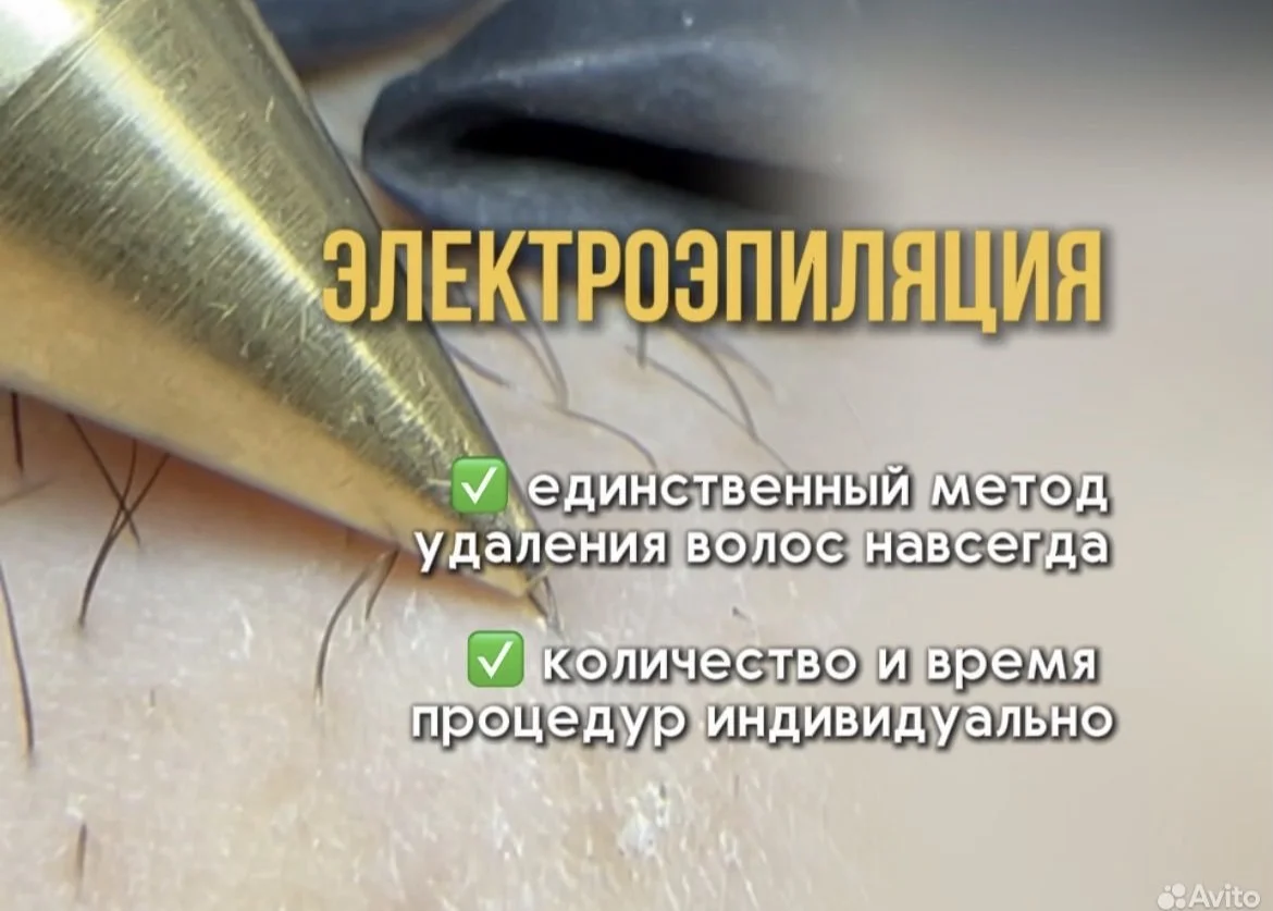 Электроэпиляция - миниатюра 2