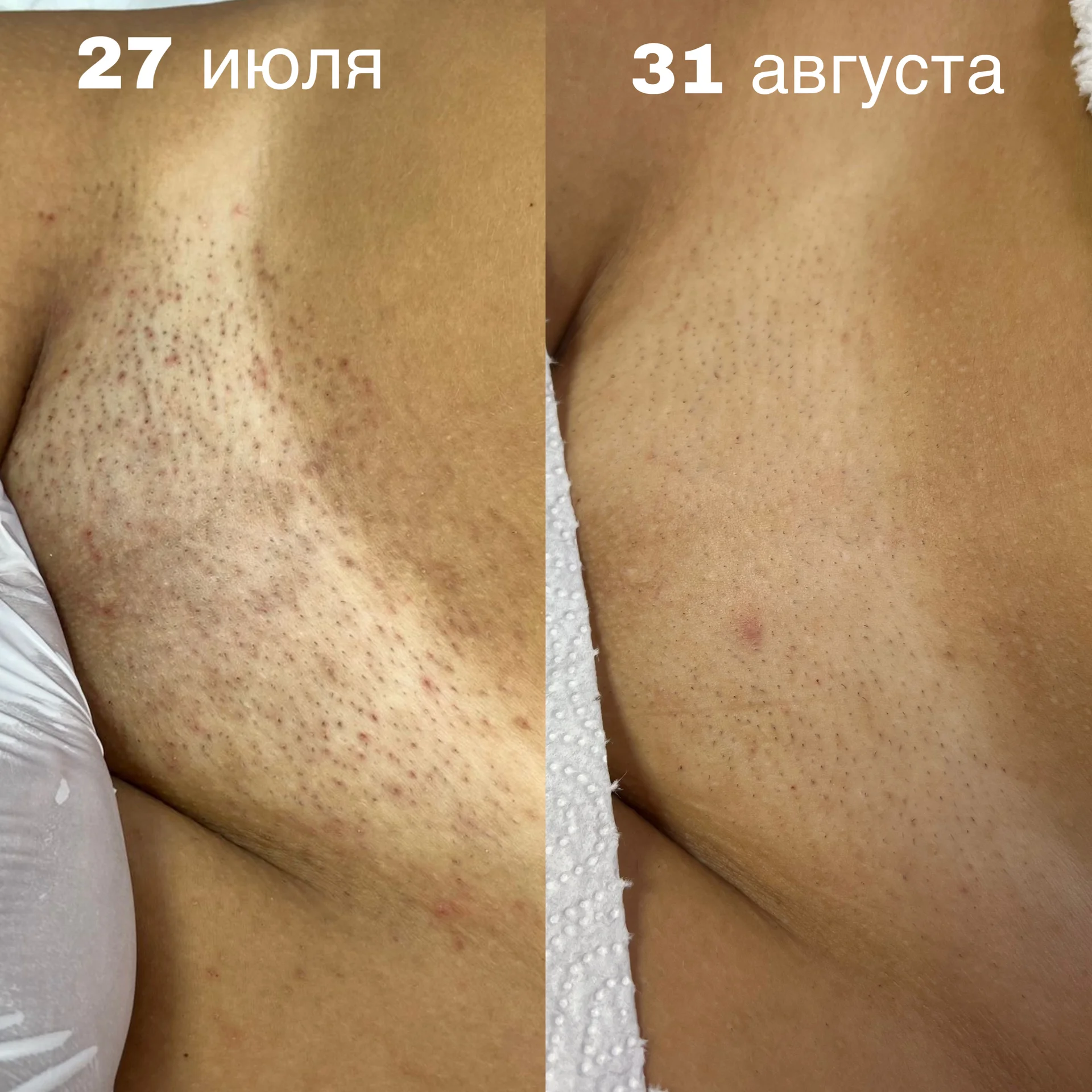 Лазерная эпиляция для мужчин и женщин - миниатюра 3