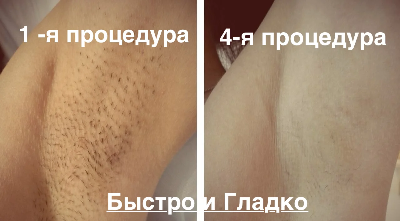 Лазерная эпиляция, удаление волос - миниатюра 2