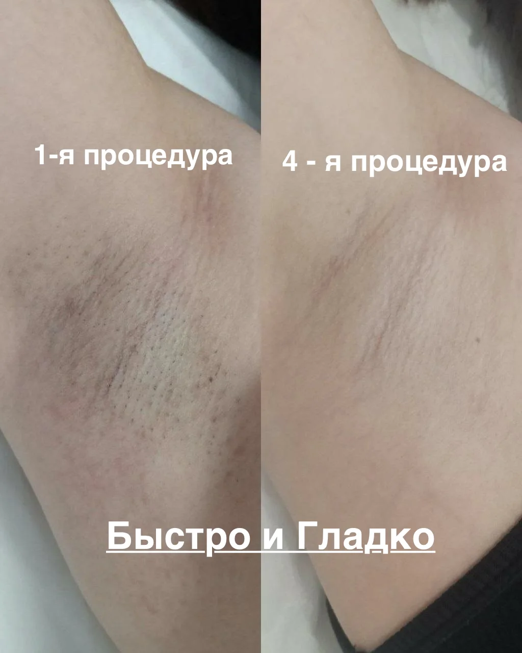 Лазерная эпиляция, удаление волос - миниатюра 3