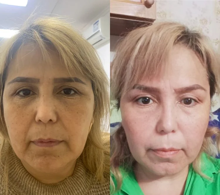 SMAS лифтинг СМАС - миниатюра 8