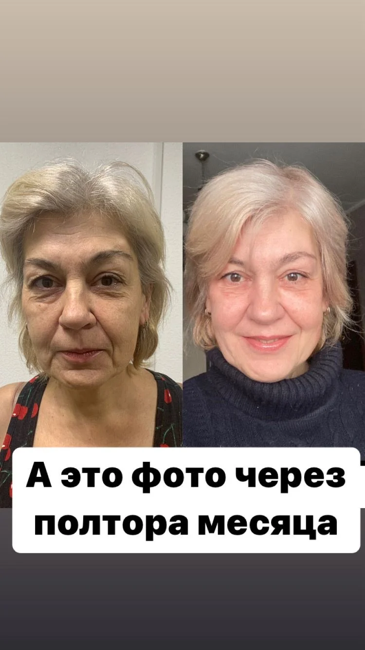 SMAS лифтинг СМАС - миниатюра 10