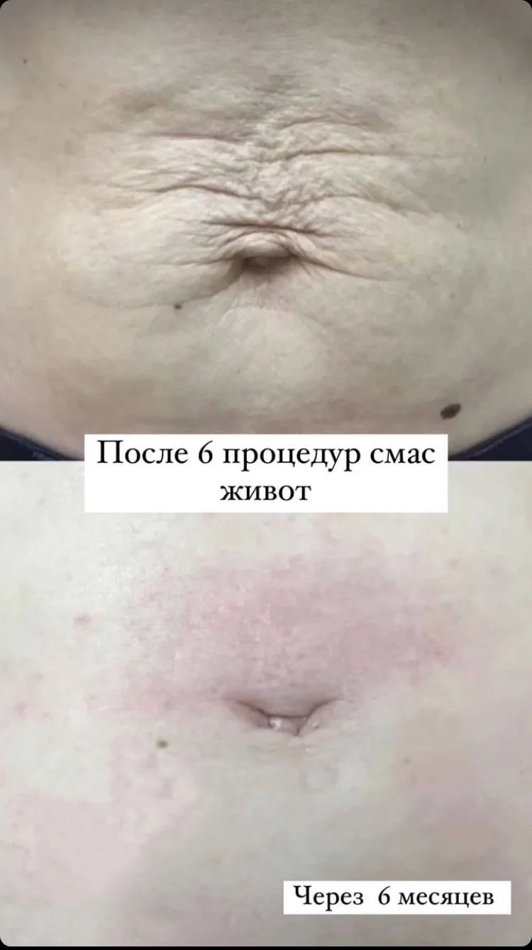 SMAS лифтинг СМАС - миниатюра 12