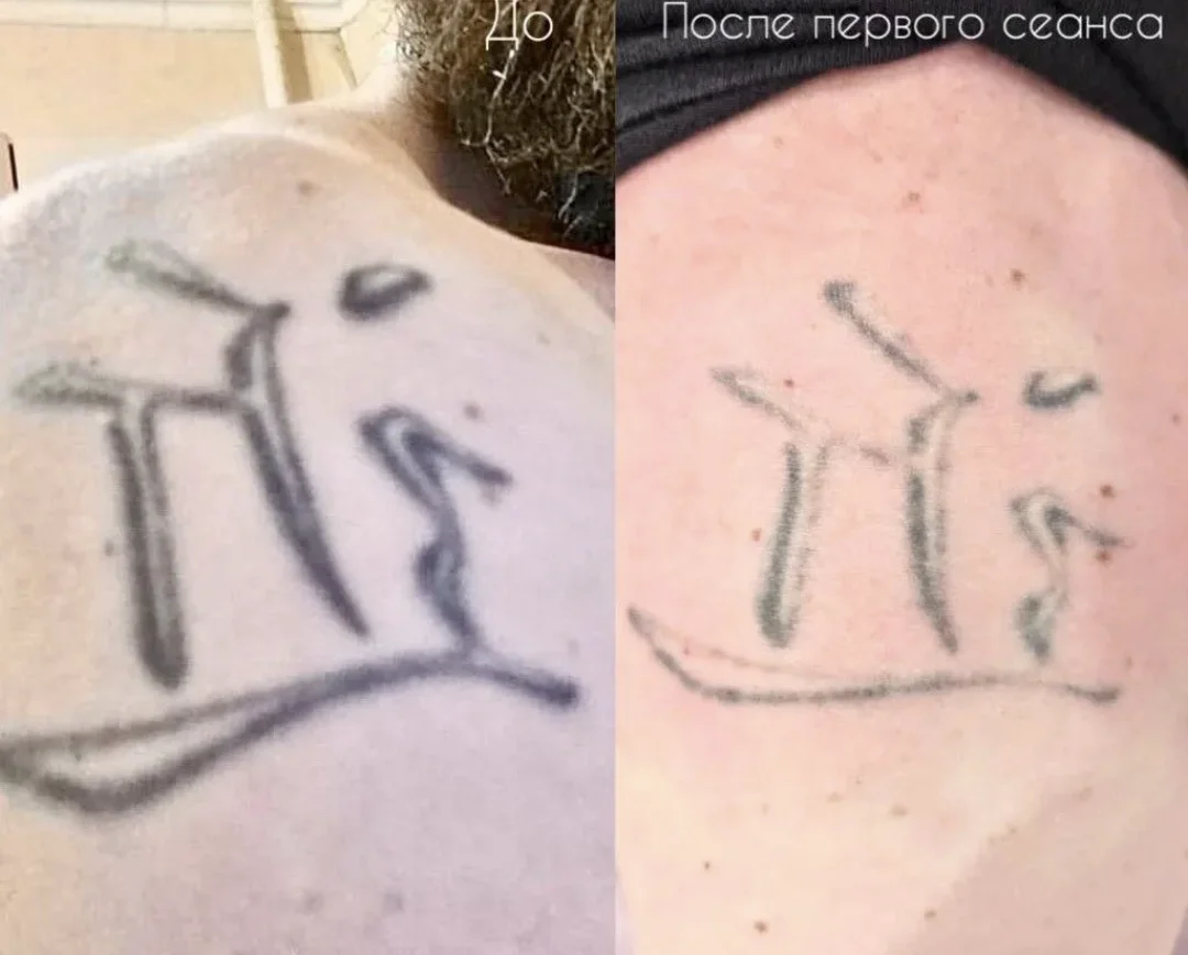 Удаление татуировок и татуажа - миниатюра 5
