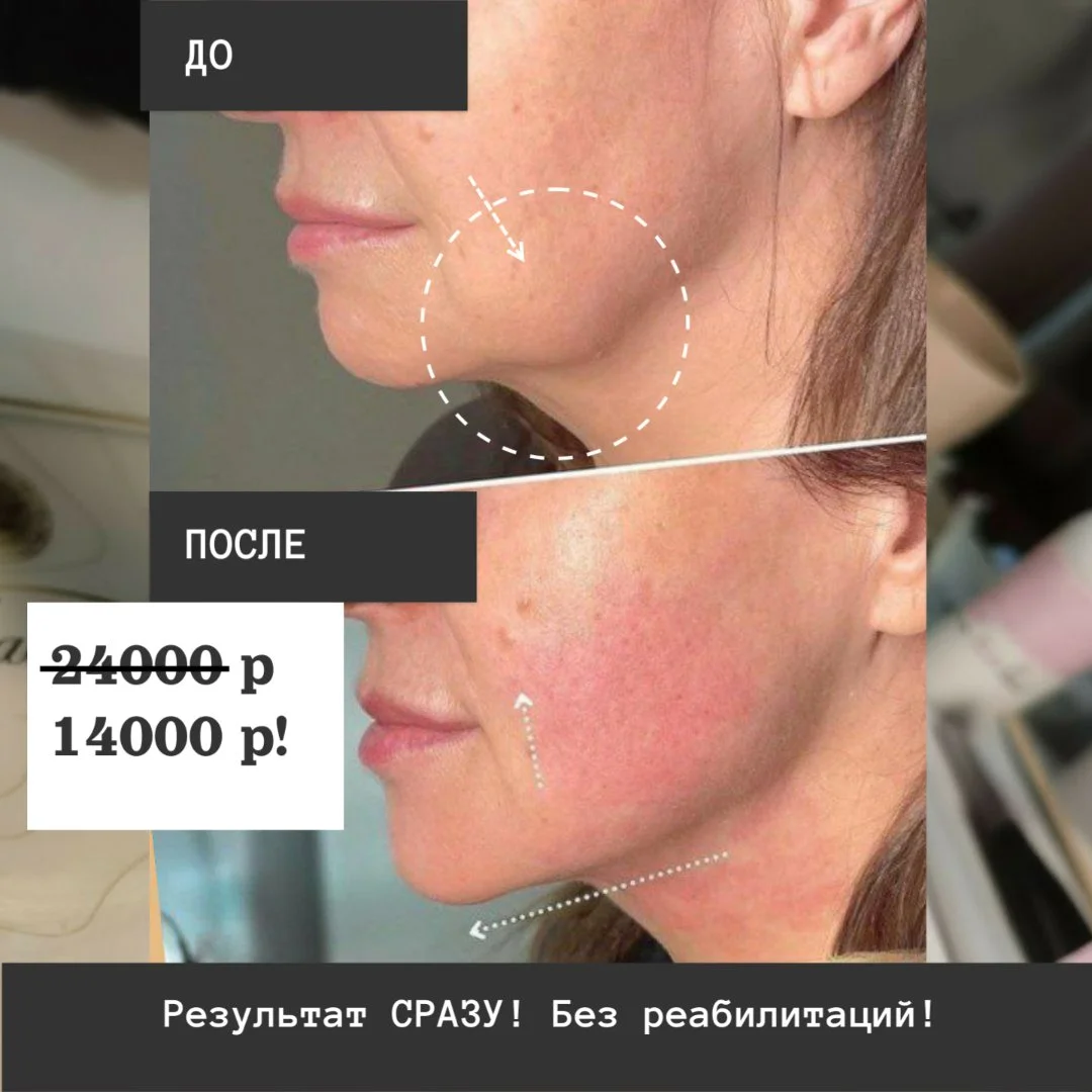 СМАС-лифтинг - молодость без операций - изображение 1
