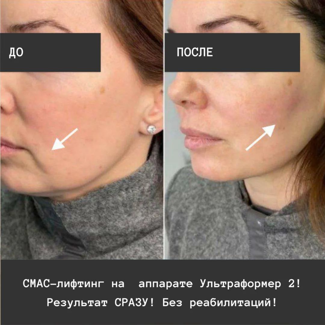 СМАС-лифтинг - молодость без операций - миниатюра 2