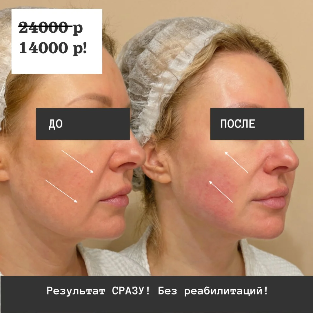 СМАС-лифтинг - молодость без операций - миниатюра 4
