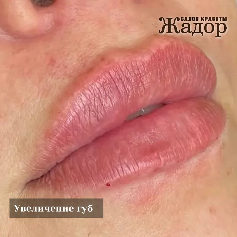 Контурная пластика и увеличение губ в Жадор - изображение 1