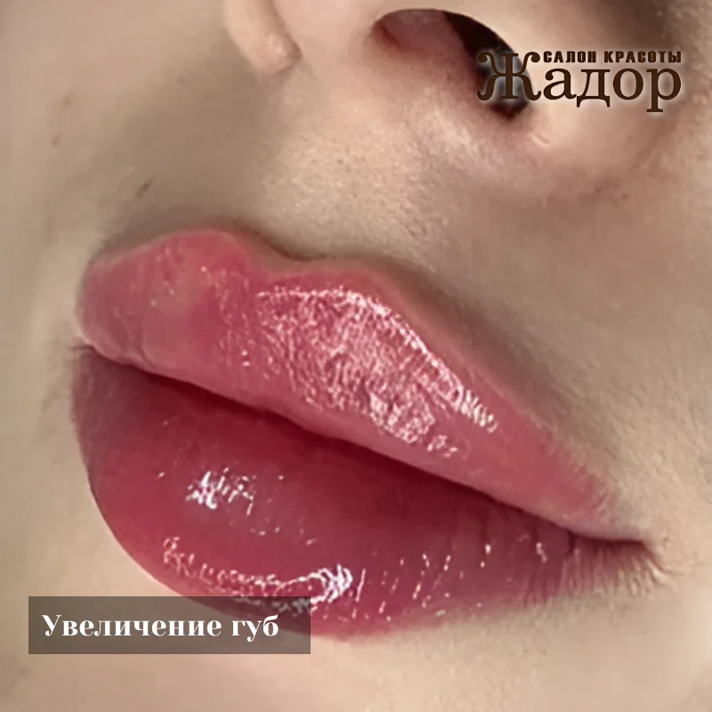 Контурная пластика и увеличение губ в Жадор - миниатюра 2