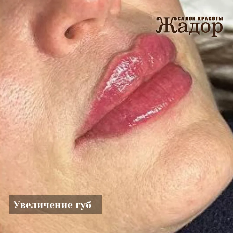 Контурная пластика и увеличение губ в Жадор - миниатюра 3