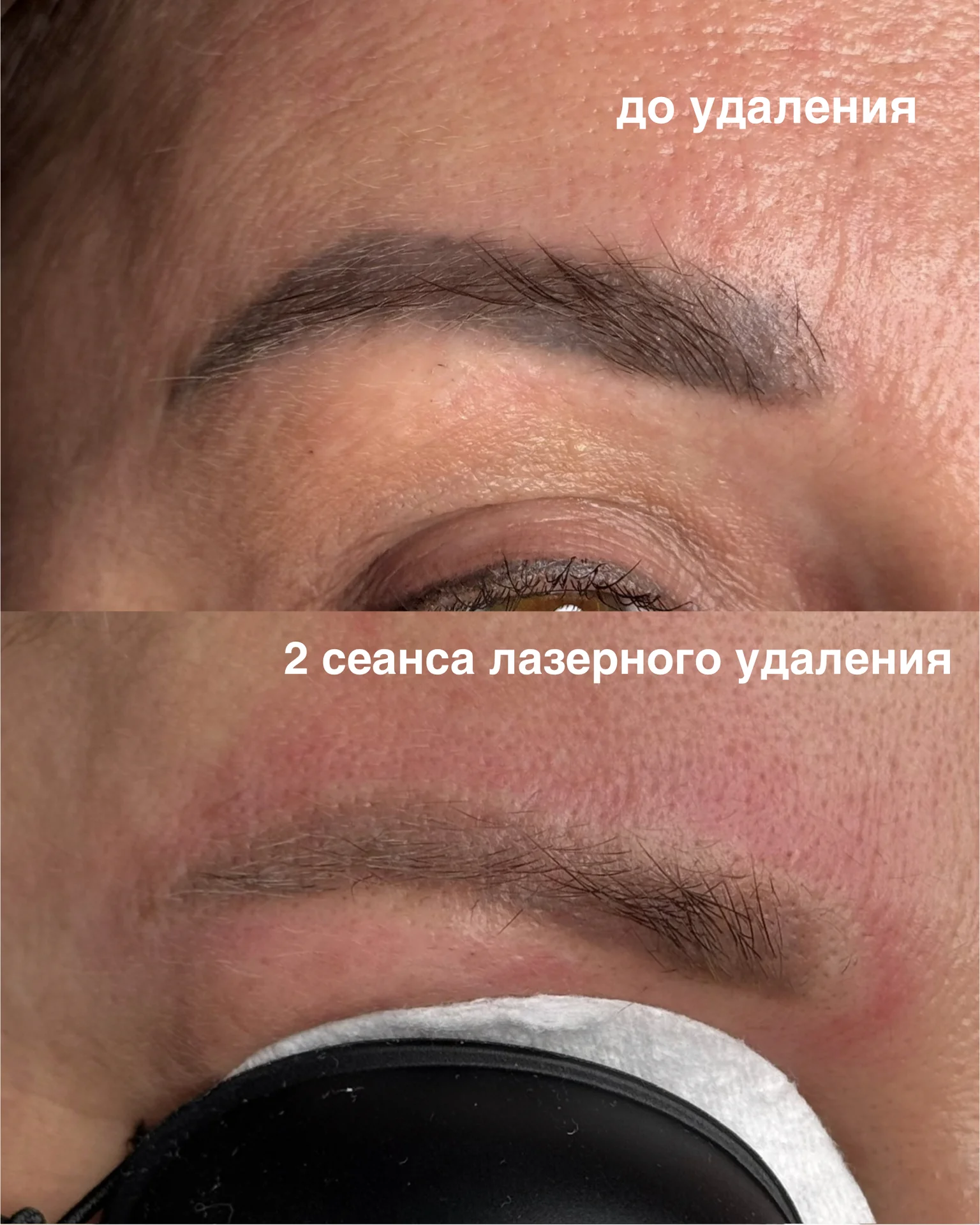 Лазерное удаление татуажа, перманента - миниатюра 5