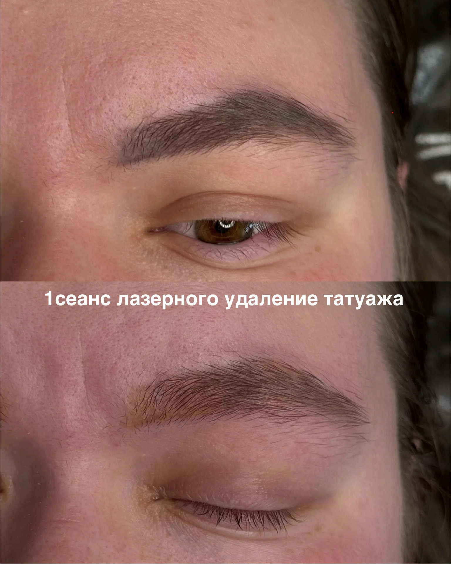 Лазерное удаление татуажа, перманента - миниатюра 6