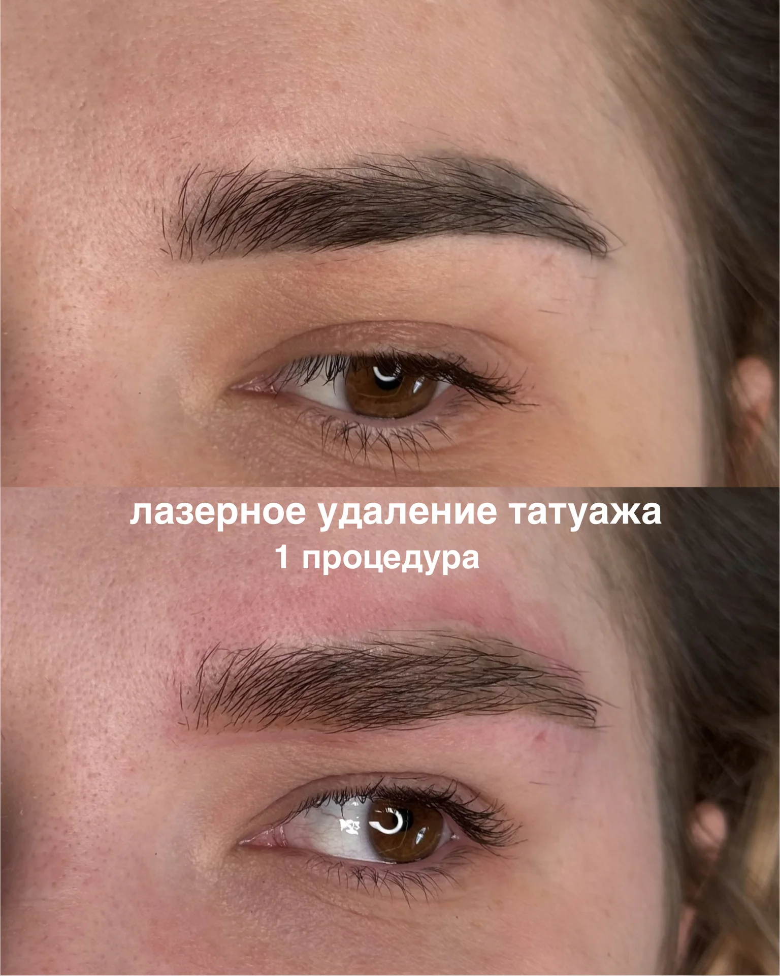 Лазерное удаление татуажа, перманента - миниатюра 7