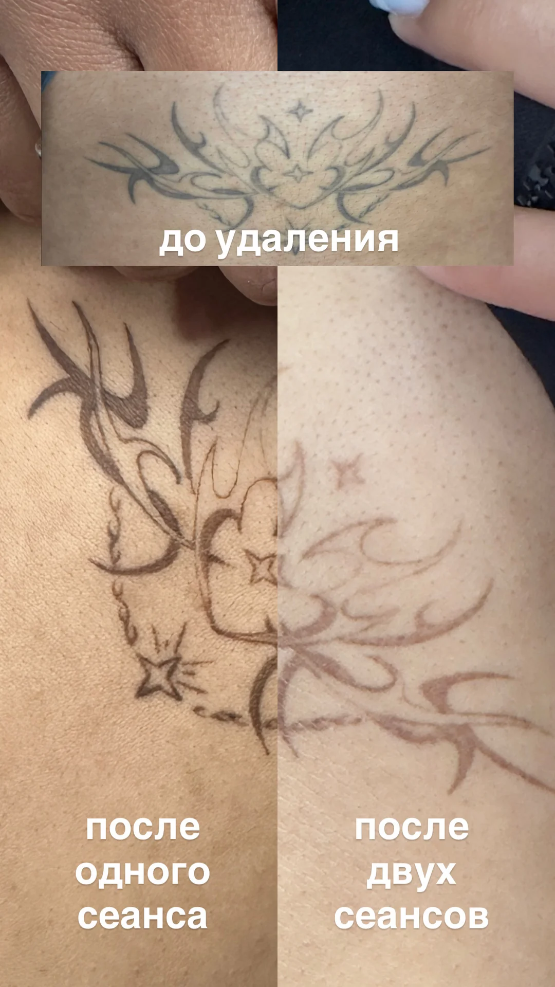 Лазерное удаление тату, перманента | Щербинка - миниатюра 2
