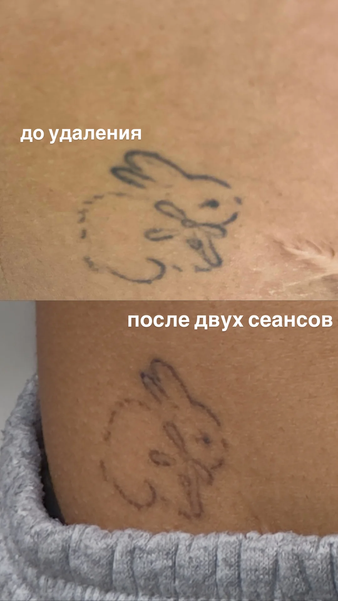 Лазерное удаление тату, перманента | Щербинка - миниатюра 4