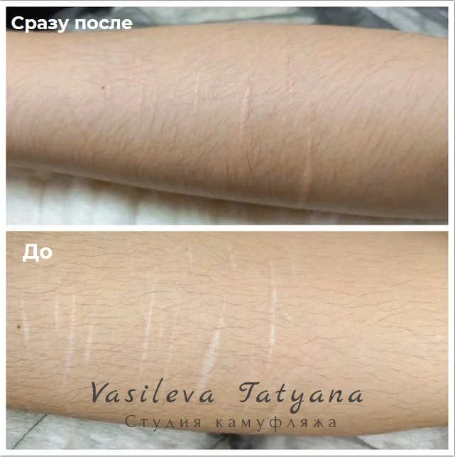 Камуфляж шрамов растяжек трихопигментация - миниатюра 2