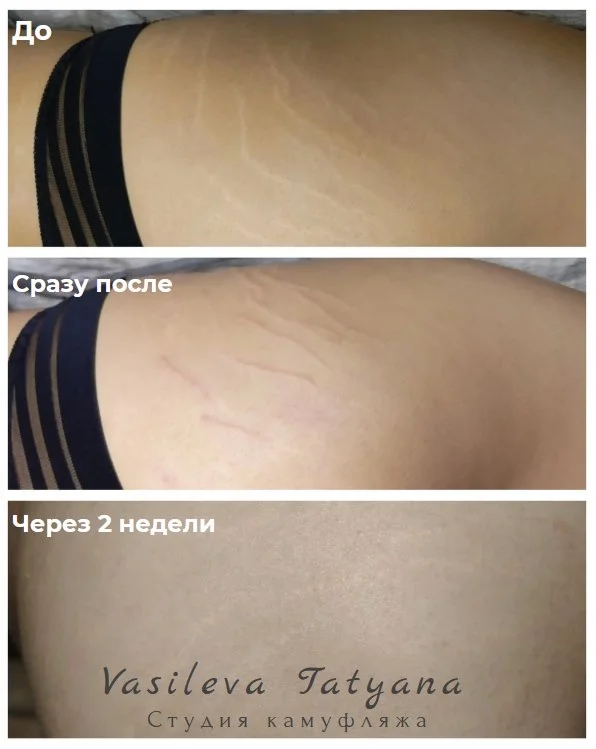 Камуфляж шрамов растяжек трихопигментация - миниатюра 3