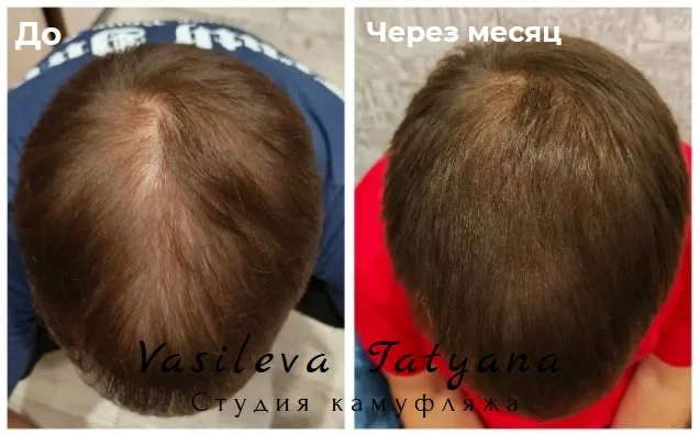 Камуфляж шрамов растяжек трихопигментация - миниатюра 4