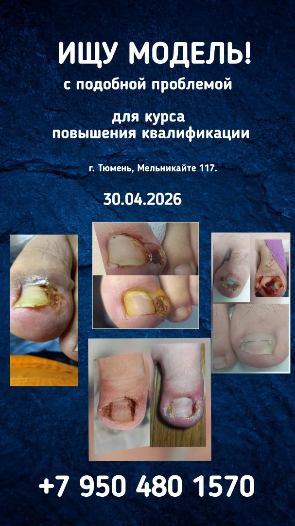 Вросший ноготь - изображение 1