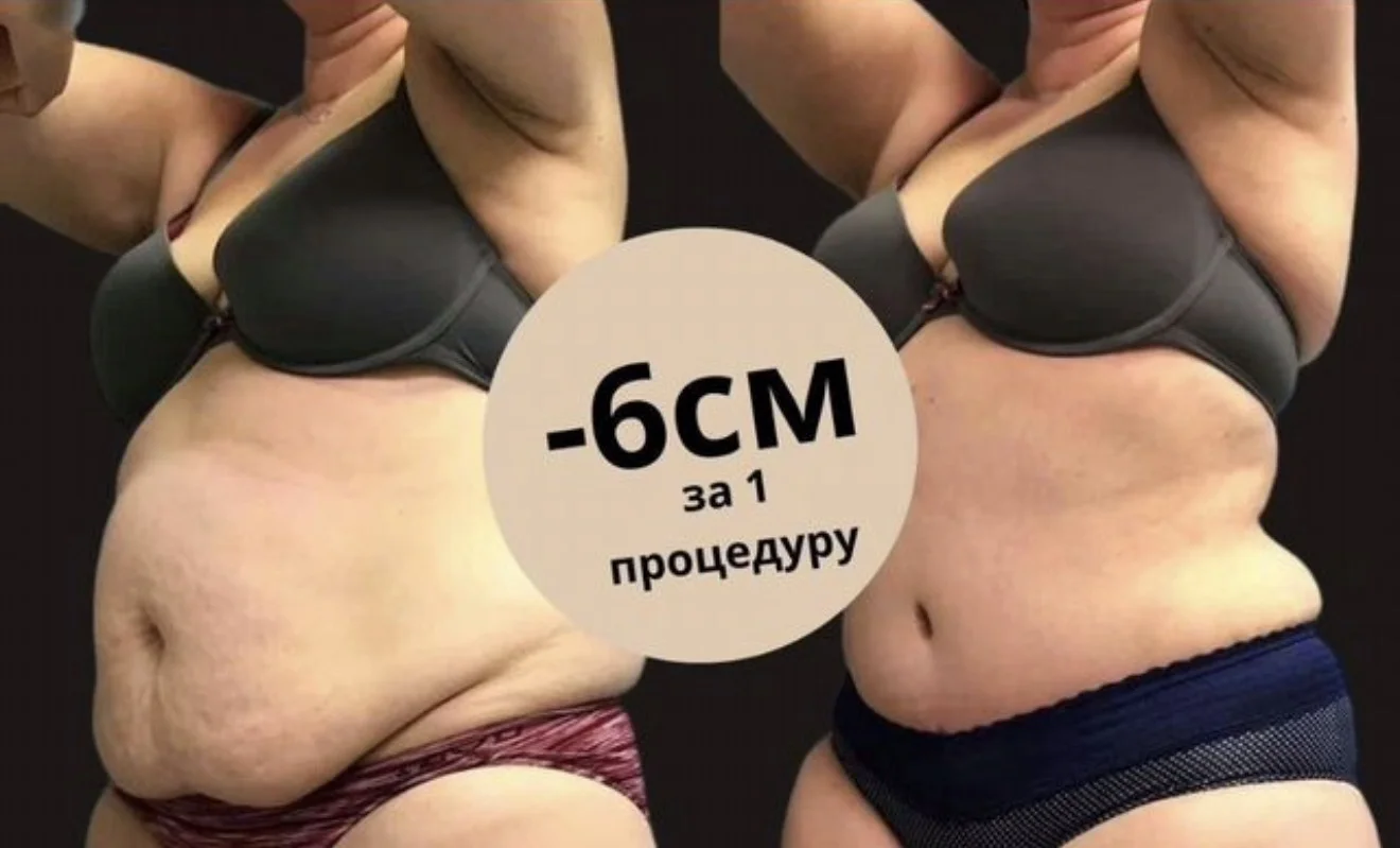 Коррекция фигуры в Северном Бутово - изображение 1