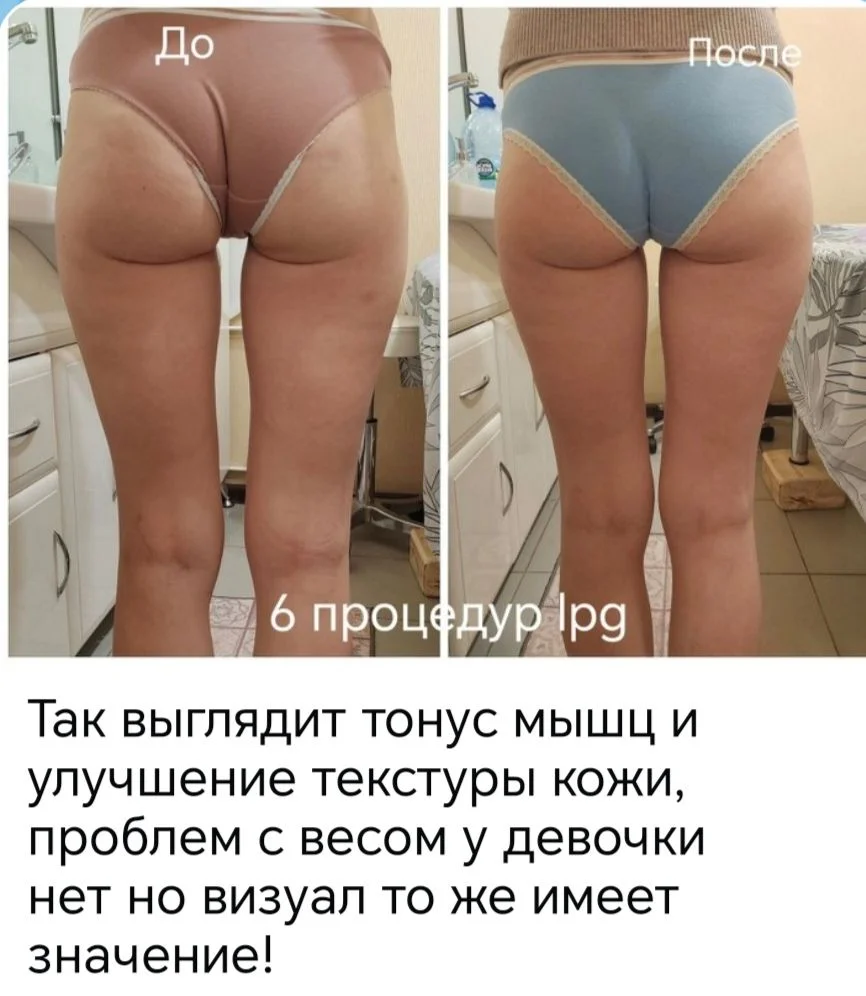 lpg массаж - миниатюра 2