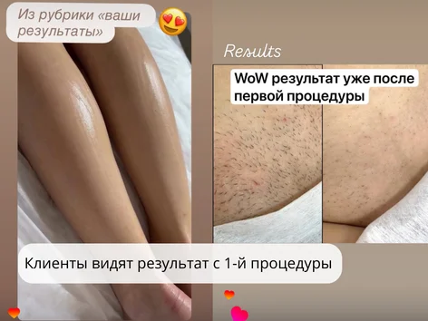 Аренда аппарата для лазерной эпиляции - миниатюра 4