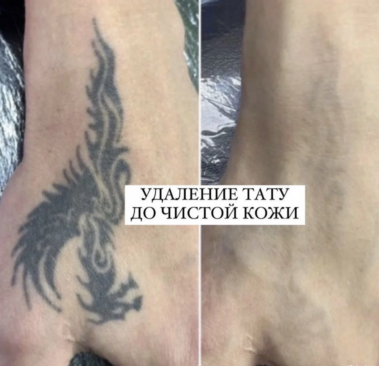 Удаление тату и татуажа бровей губ век лазером - миниатюра 2