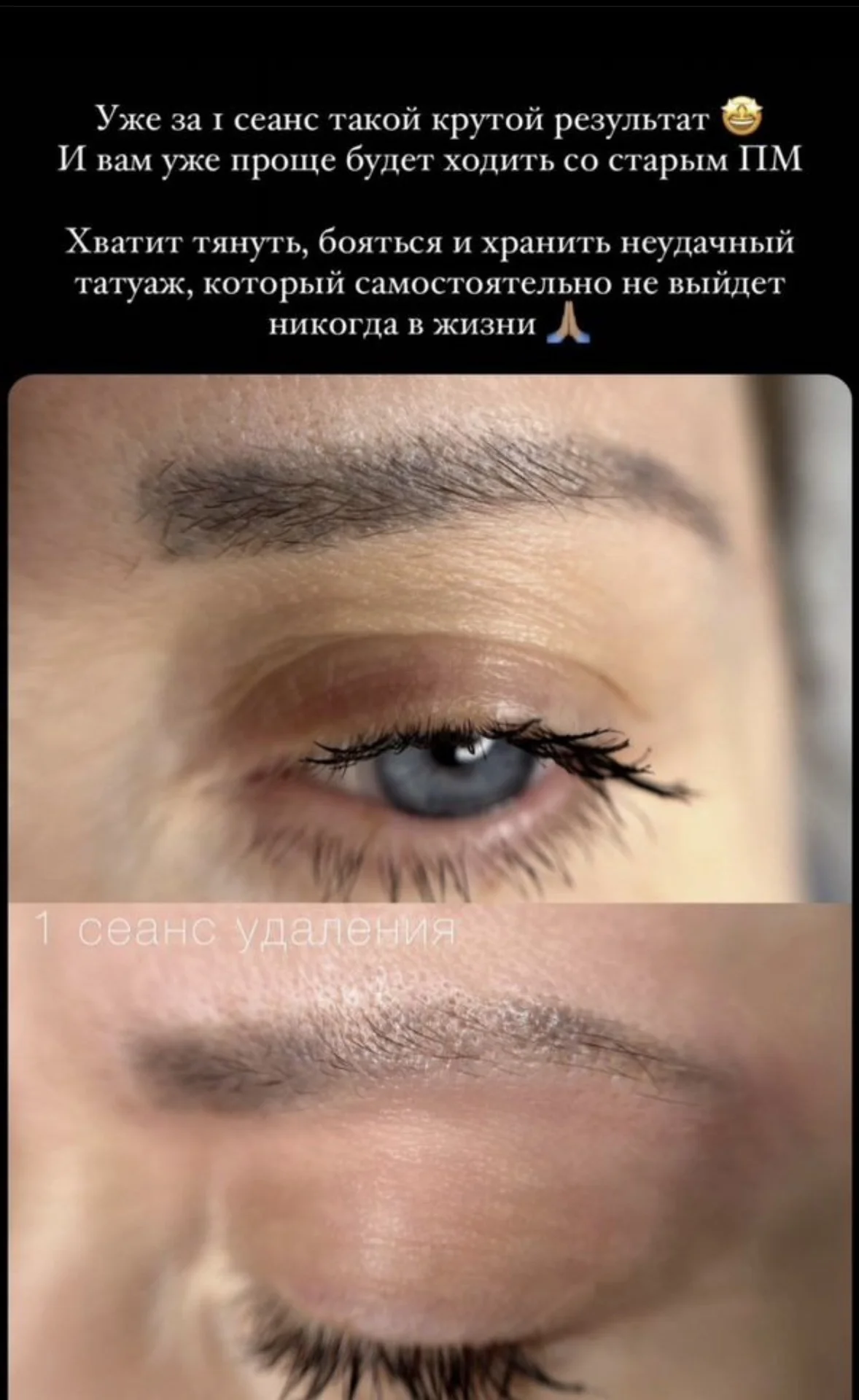 Удаление тату и татуажа бровей губ век лазером - миниатюра 5