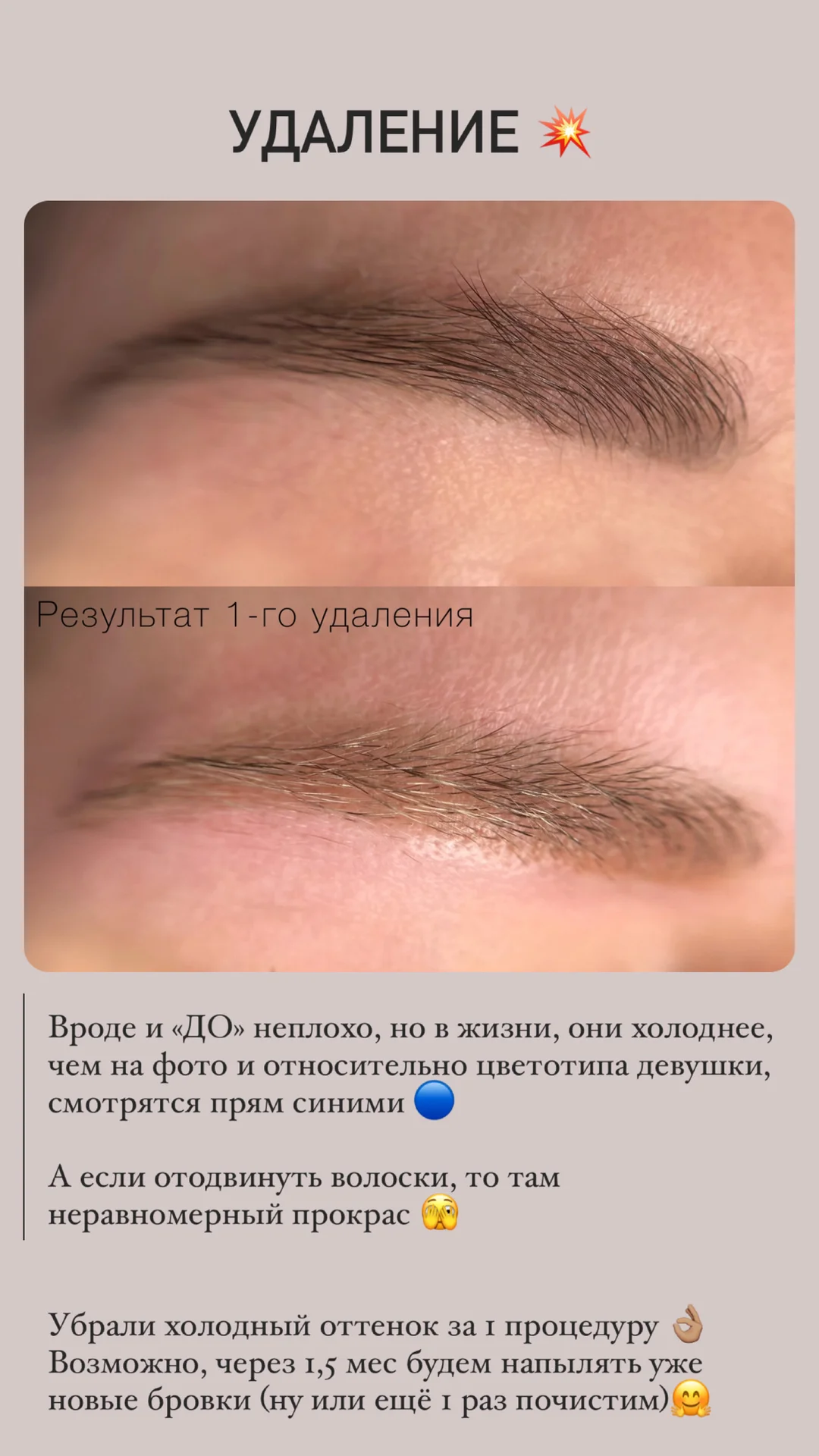 Удаление тату и татуажа бровей губ век лазером - миниатюра 8