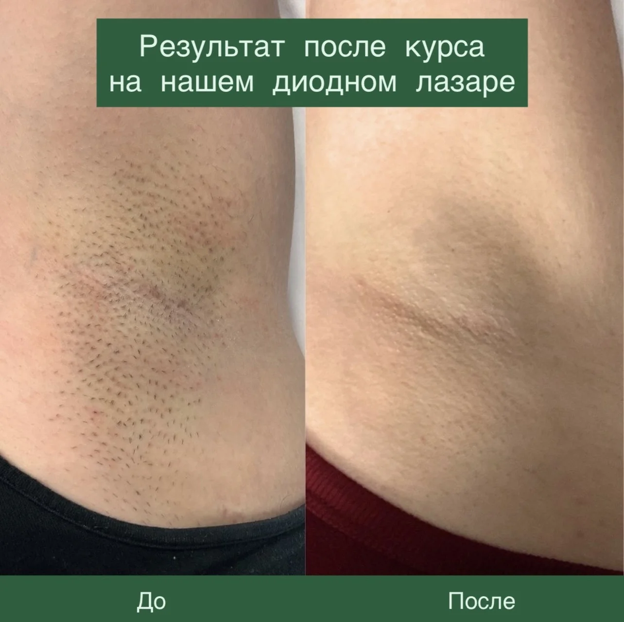 Лазерная эпиляция - миниатюра 7