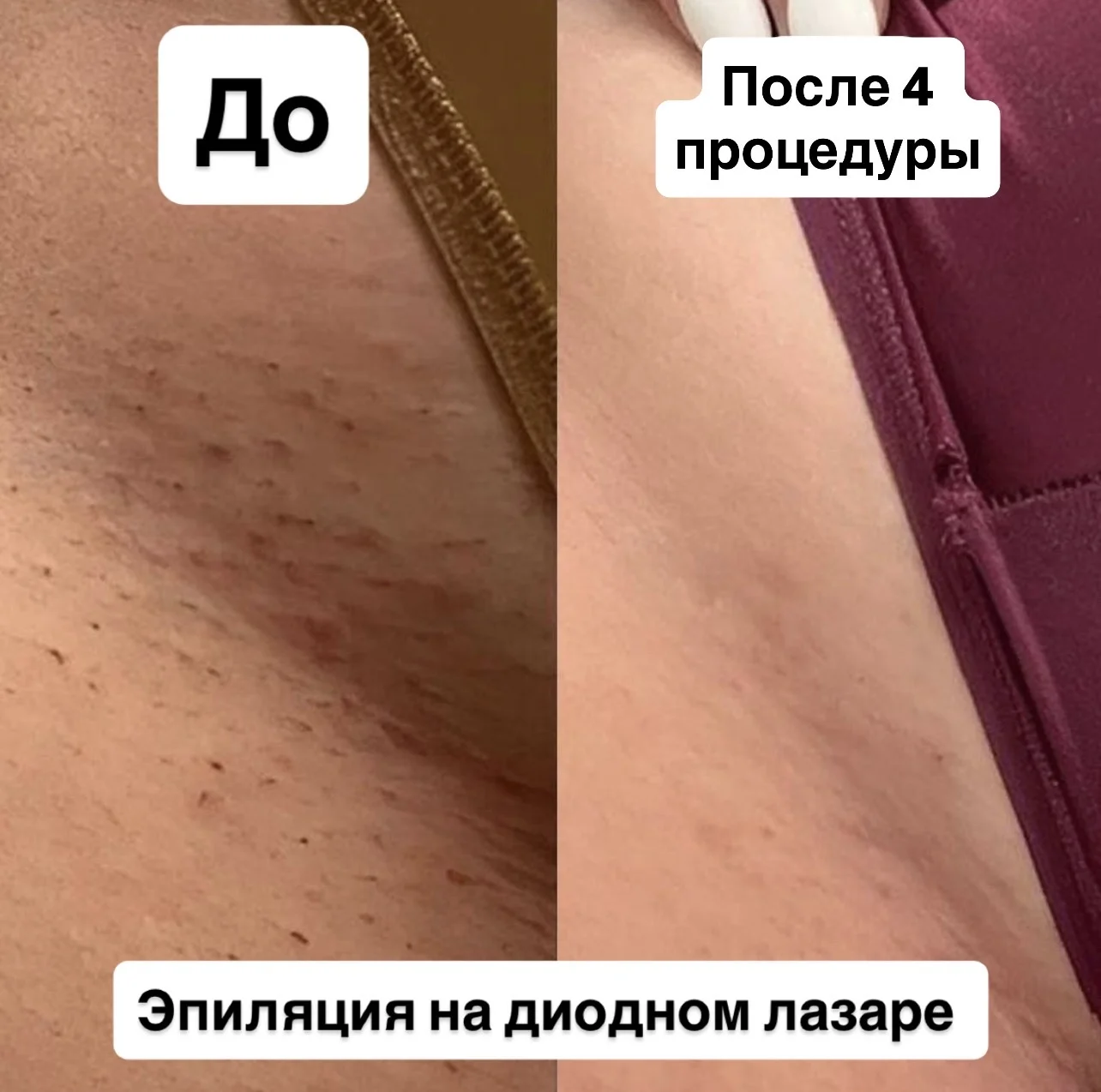 Лазерная эпиляция - миниатюра 9
