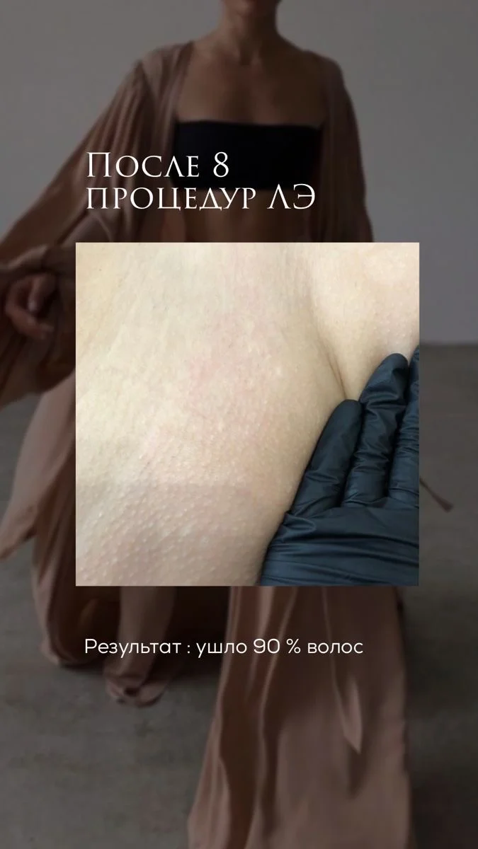 Лазерная эпиляция - миниатюра 12