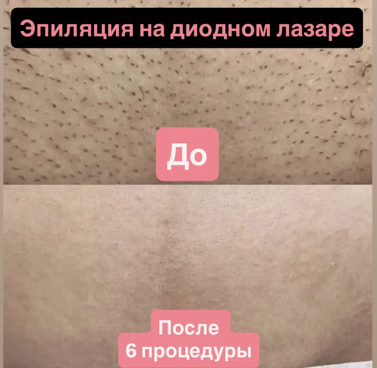 Лазерная эпиляция - миниатюра 15