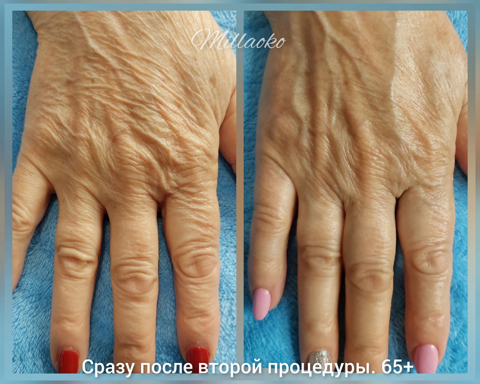 Здоровое омоложение Холодной плазмой - миниатюра 3
