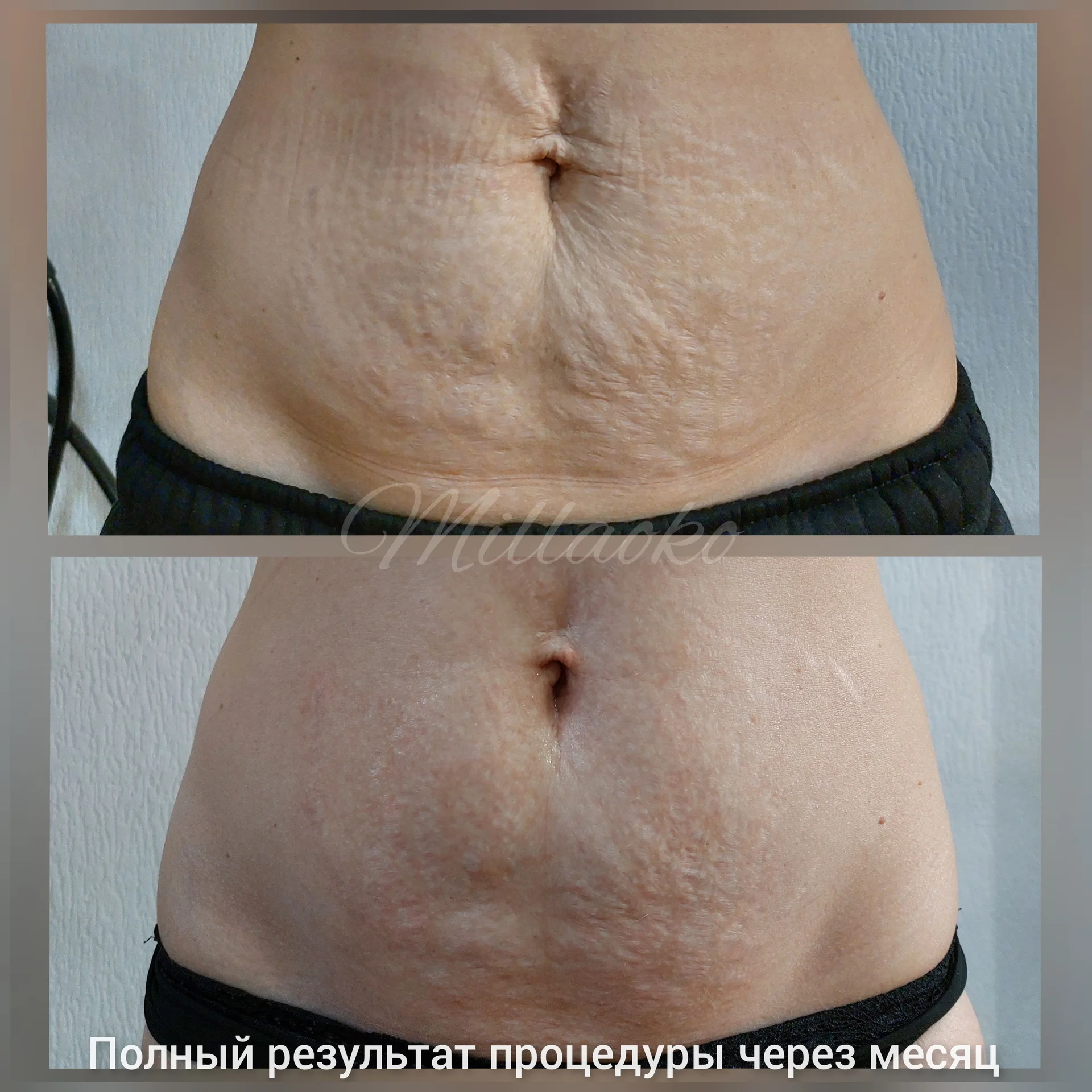 Здоровое омоложение Холодной плазмой - миниатюра 4